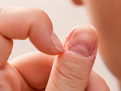 Заусенцы - проблема рук и ногтей. Как избавиться?